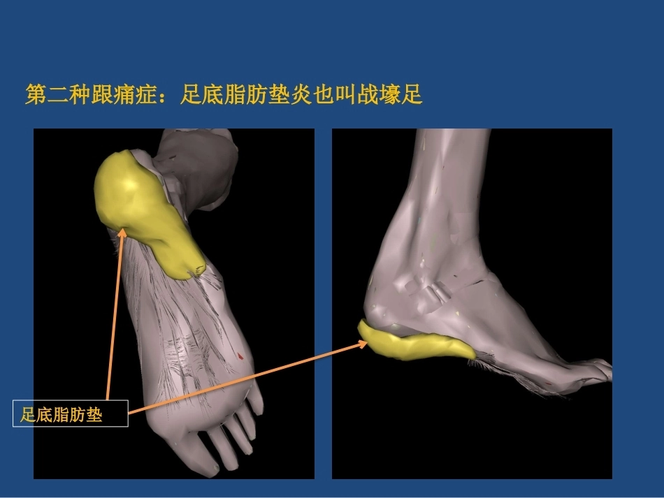 跟痛症课件(2)_第7页