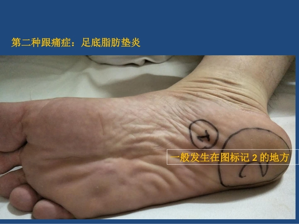跟痛症课件(2)_第8页