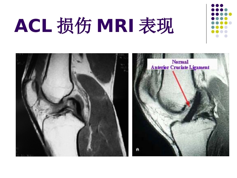 膝关节前交叉韧带损伤诊断与治疗(2)_第11页