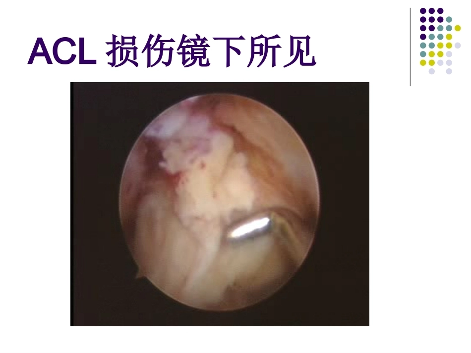 膝关节前交叉韧带损伤诊断与治疗(2)_第12页