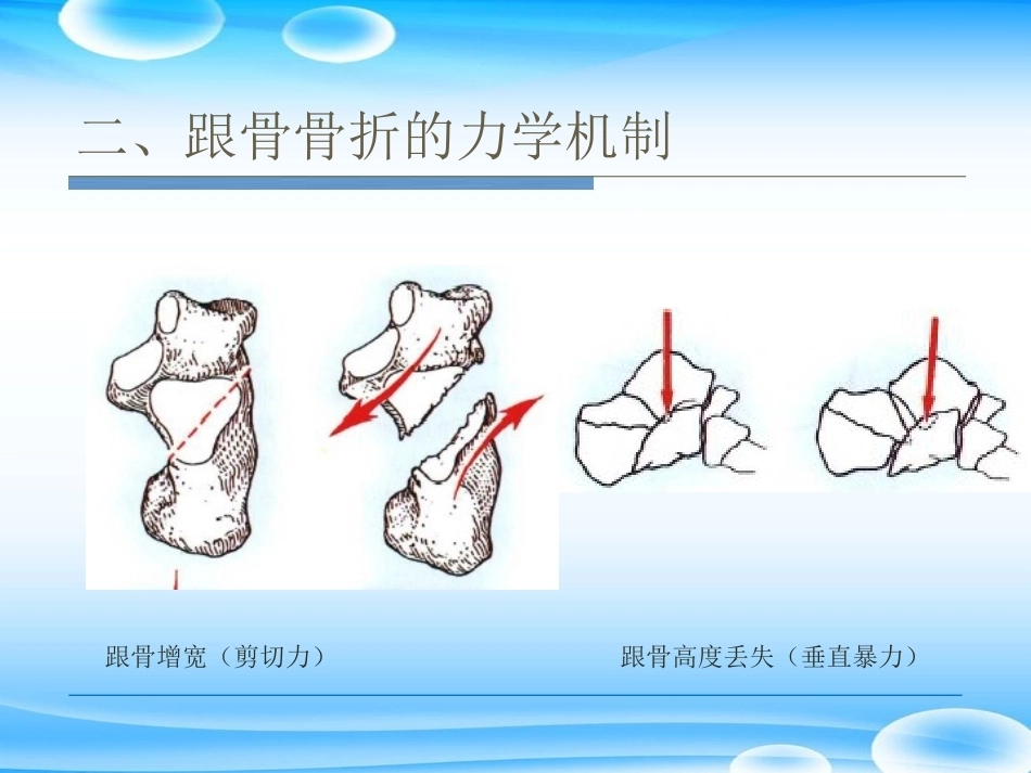 跟骨骨折ORIF的技巧PPT课件(2)_第10页