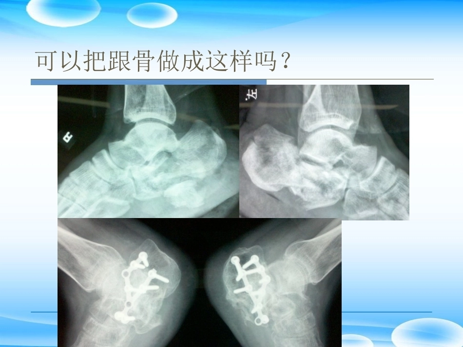 跟骨骨折ORIF的技巧PPT课件(2)_第3页
