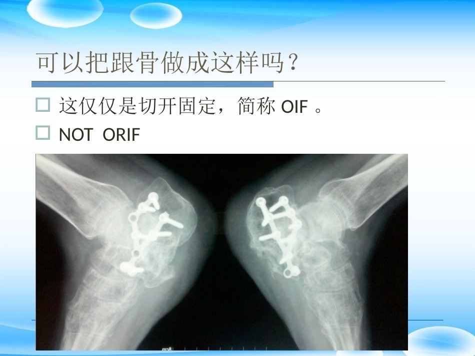 跟骨骨折ORIF的技巧PPT课件(2)_第4页
