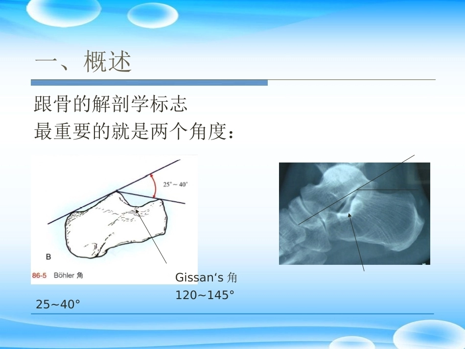 跟骨骨折ORIF的技巧PPT课件(2)_第7页
