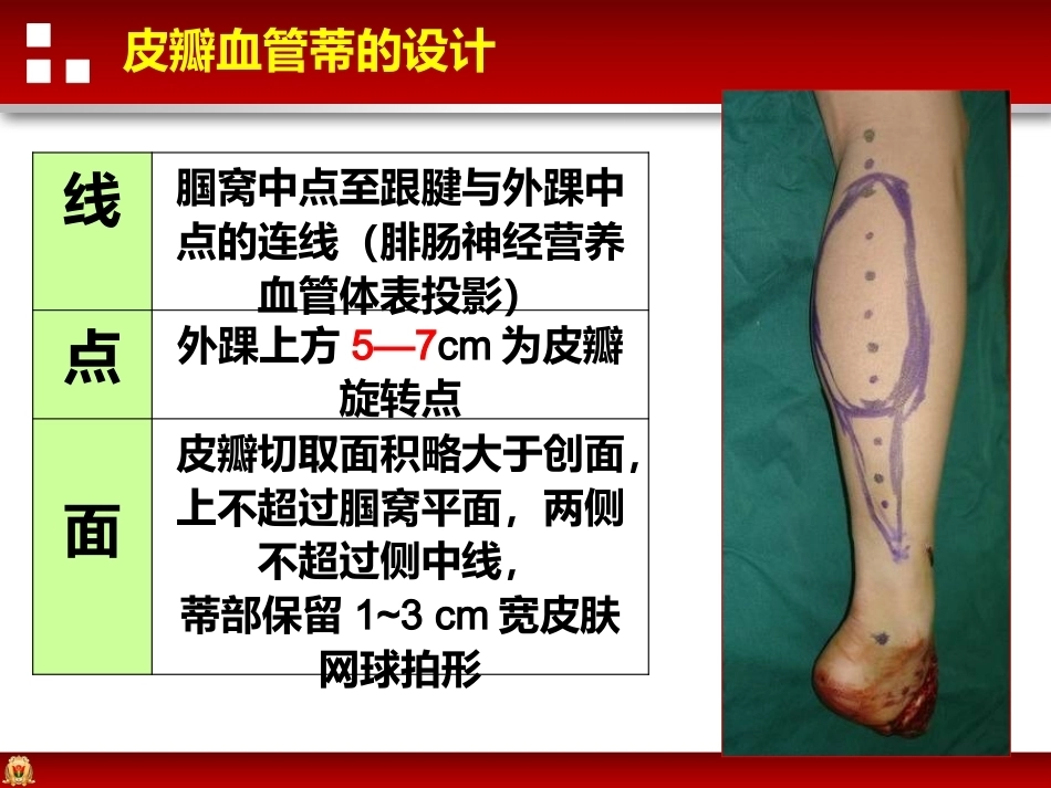 带蒂皮瓣转移修复足踝部创面(2)_第15页