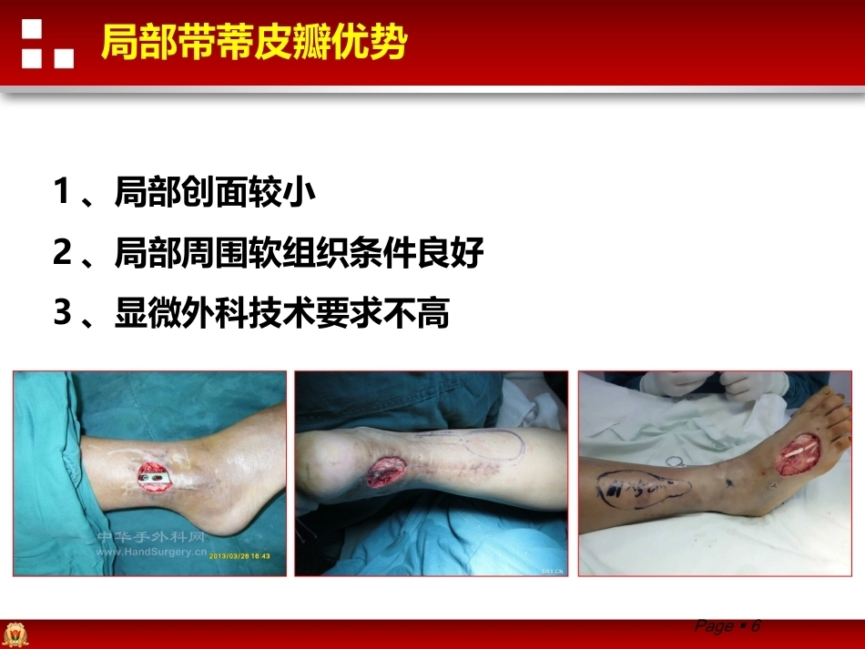 带蒂皮瓣转移修复足踝部创面(2)_第6页