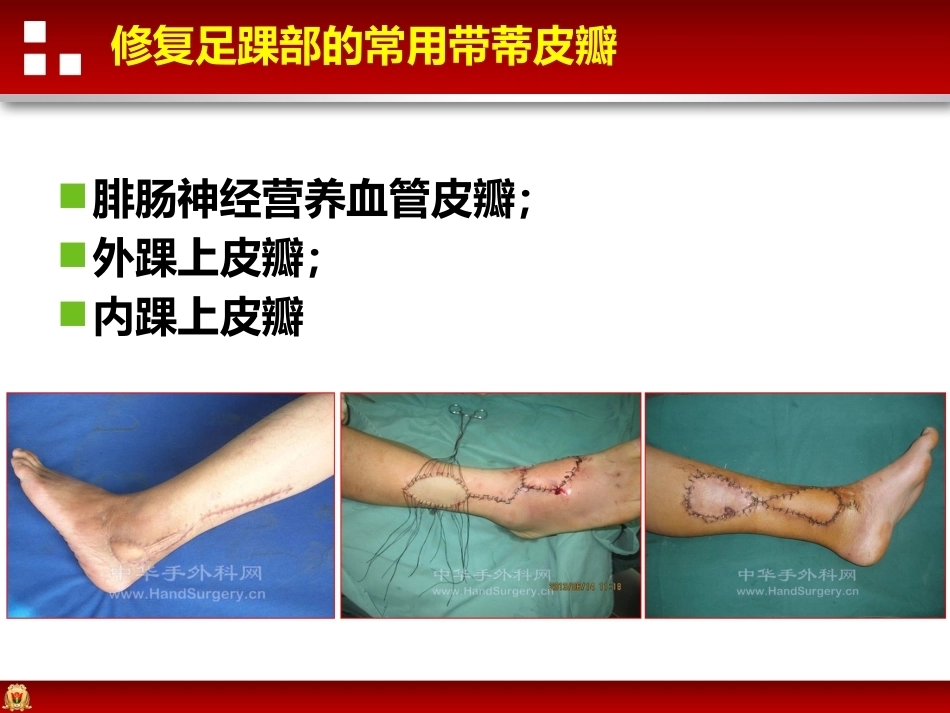 带蒂皮瓣转移修复足踝部创面(2)_第7页
