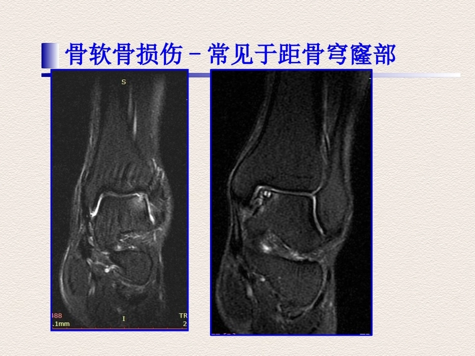 踝关节运动损伤MR诊断(4)_第11页