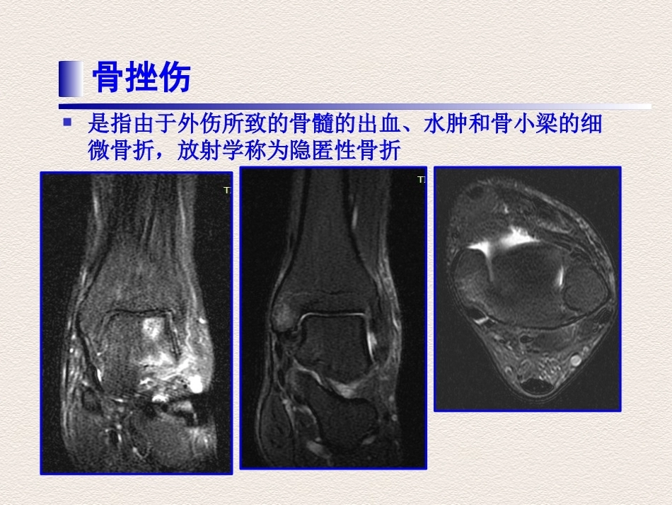 踝关节运动损伤MR诊断(4)_第14页