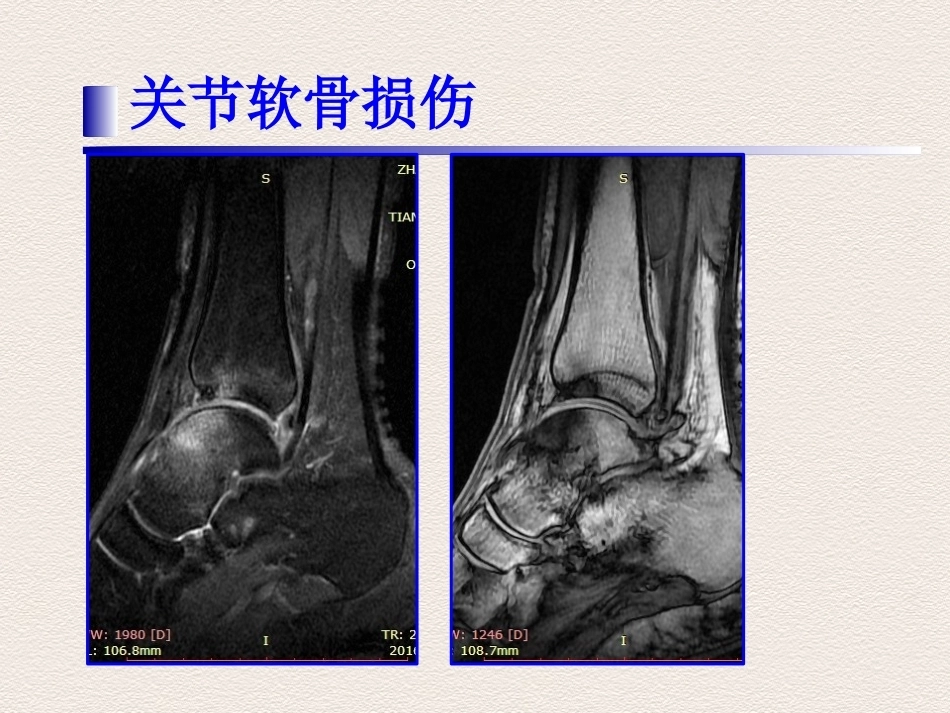 踝关节运动损伤MR诊断(4)_第5页