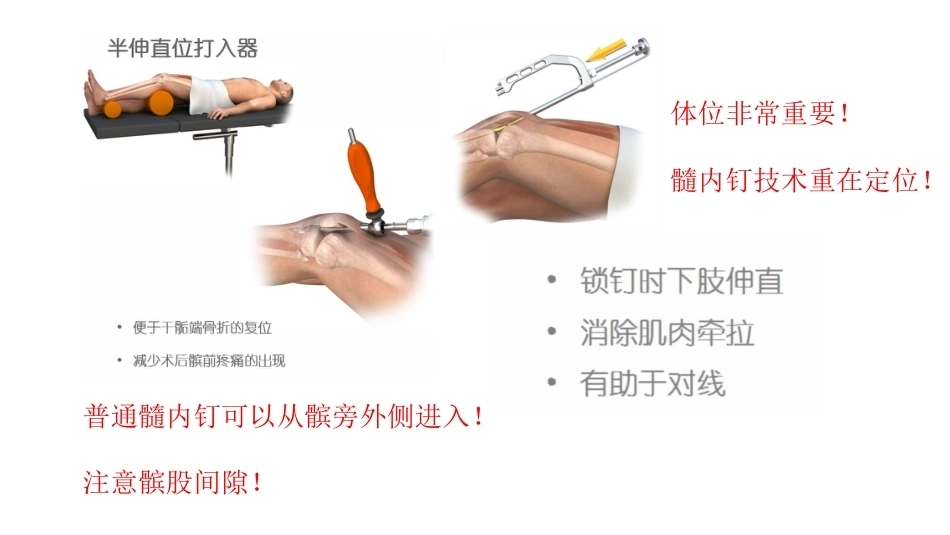 胫骨干合并后踝骨折的处理(4)_第12页