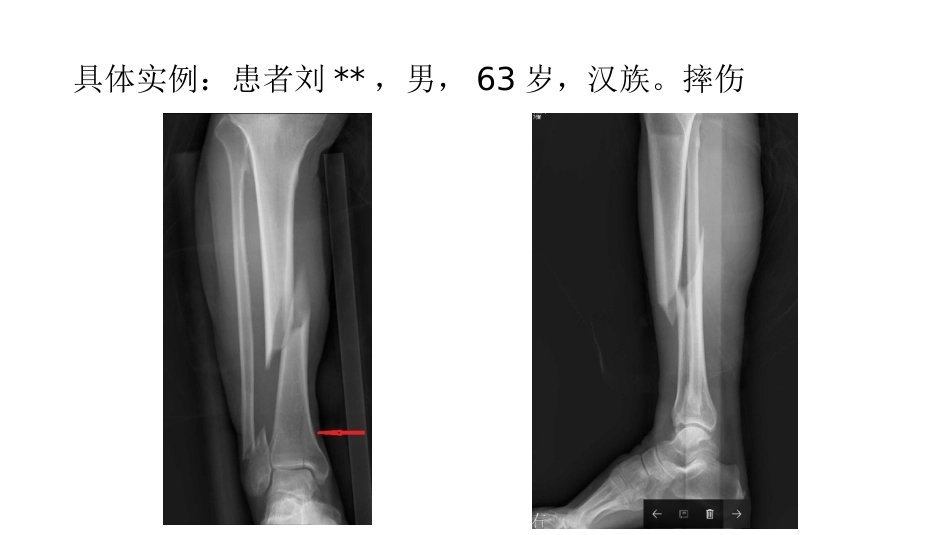 胫骨干合并后踝骨折的处理(4)_第14页