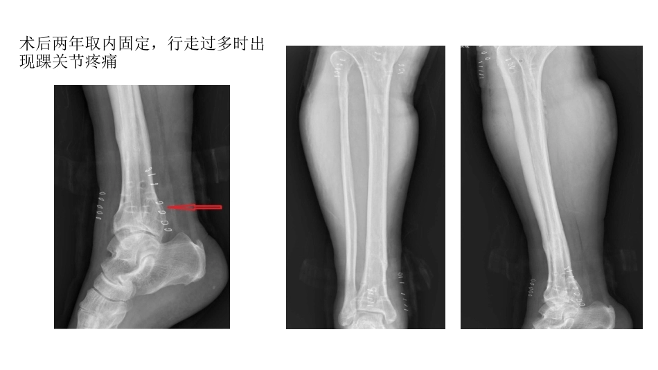 胫骨干合并后踝骨折的处理(4)_第4页