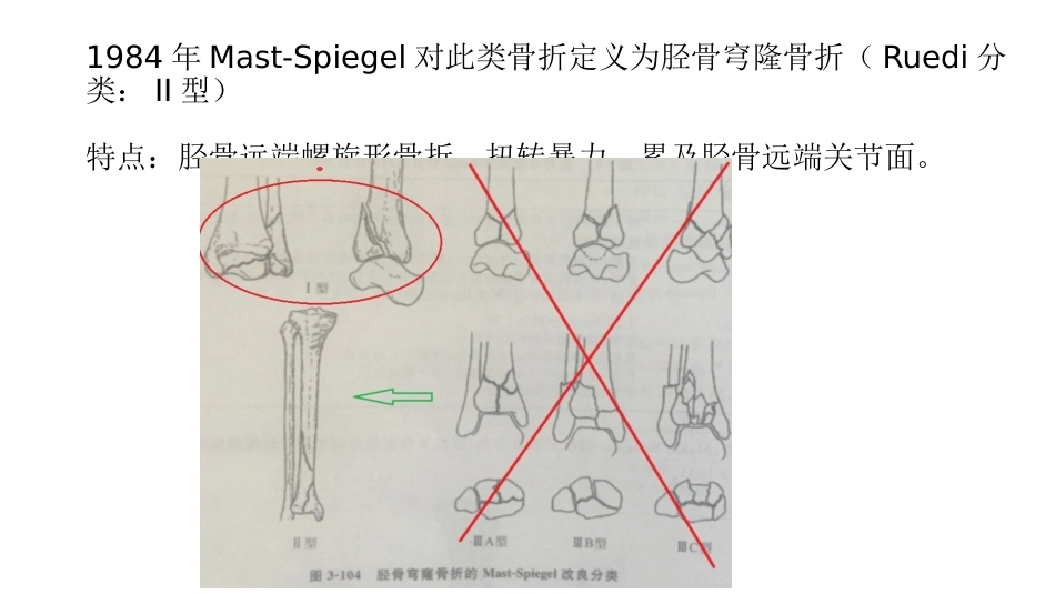 胫骨干合并后踝骨折的处理(4)_第6页