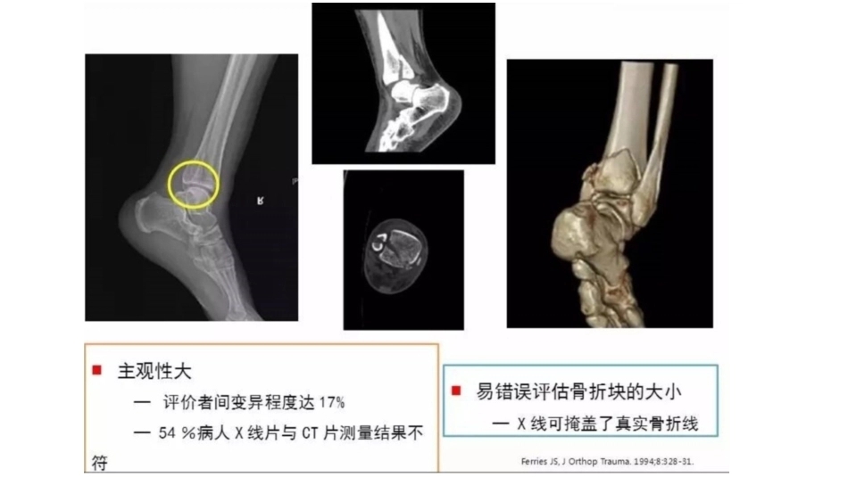 胫骨干合并后踝骨折的处理(4)_第7页