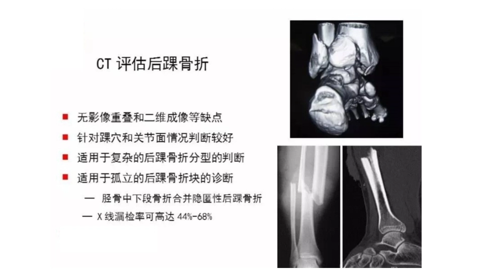 胫骨干合并后踝骨折的处理(4)_第8页
