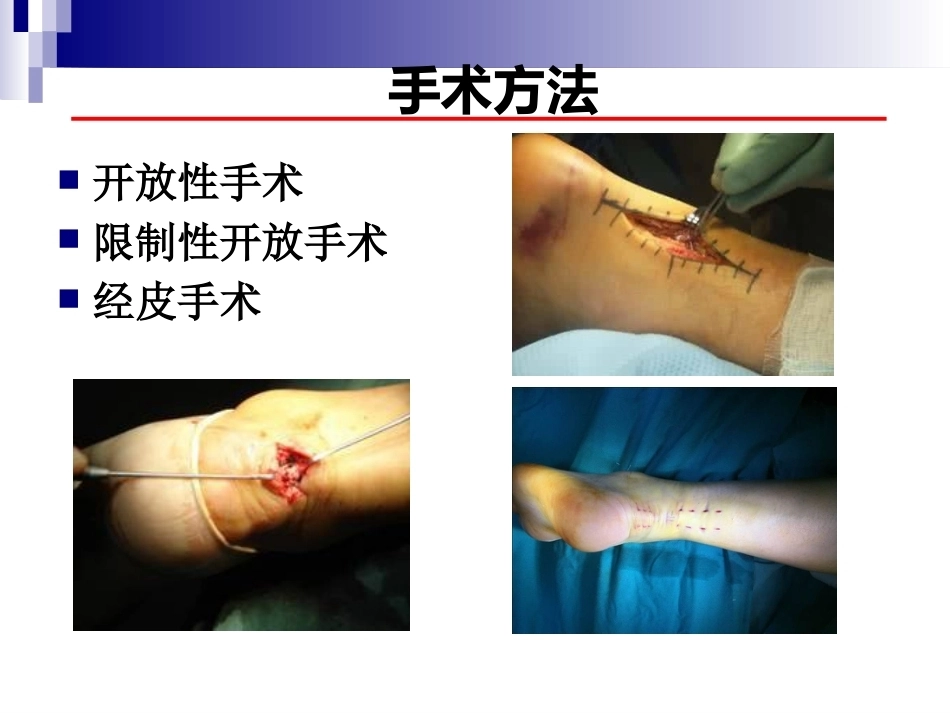 急性跟腱中部断裂的诊治(4)_第14页