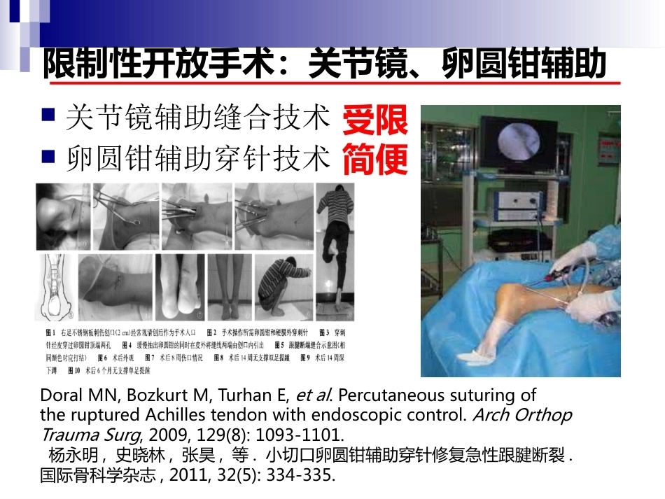 急性跟腱中部断裂的诊治(4)_第15页