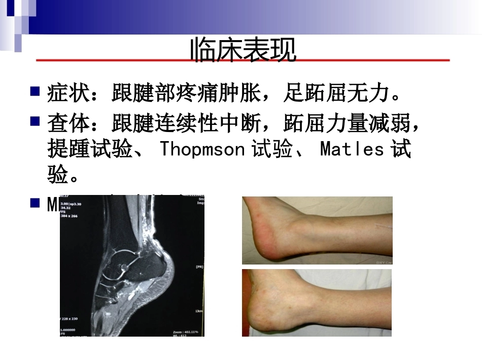 急性跟腱中部断裂的诊治(4)_第5页