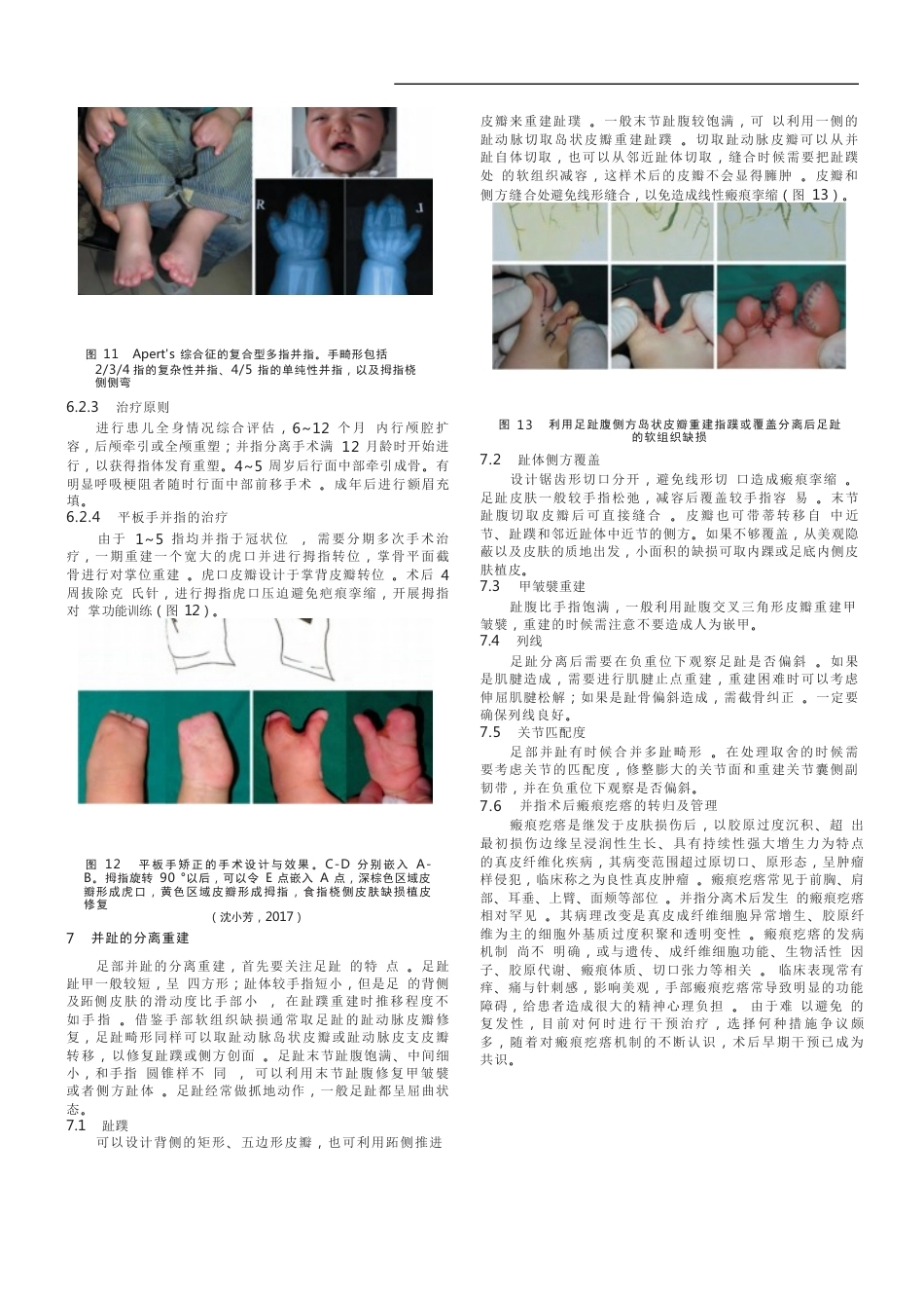 先天性并指畸形诊疗的专家共识(12)_第6页