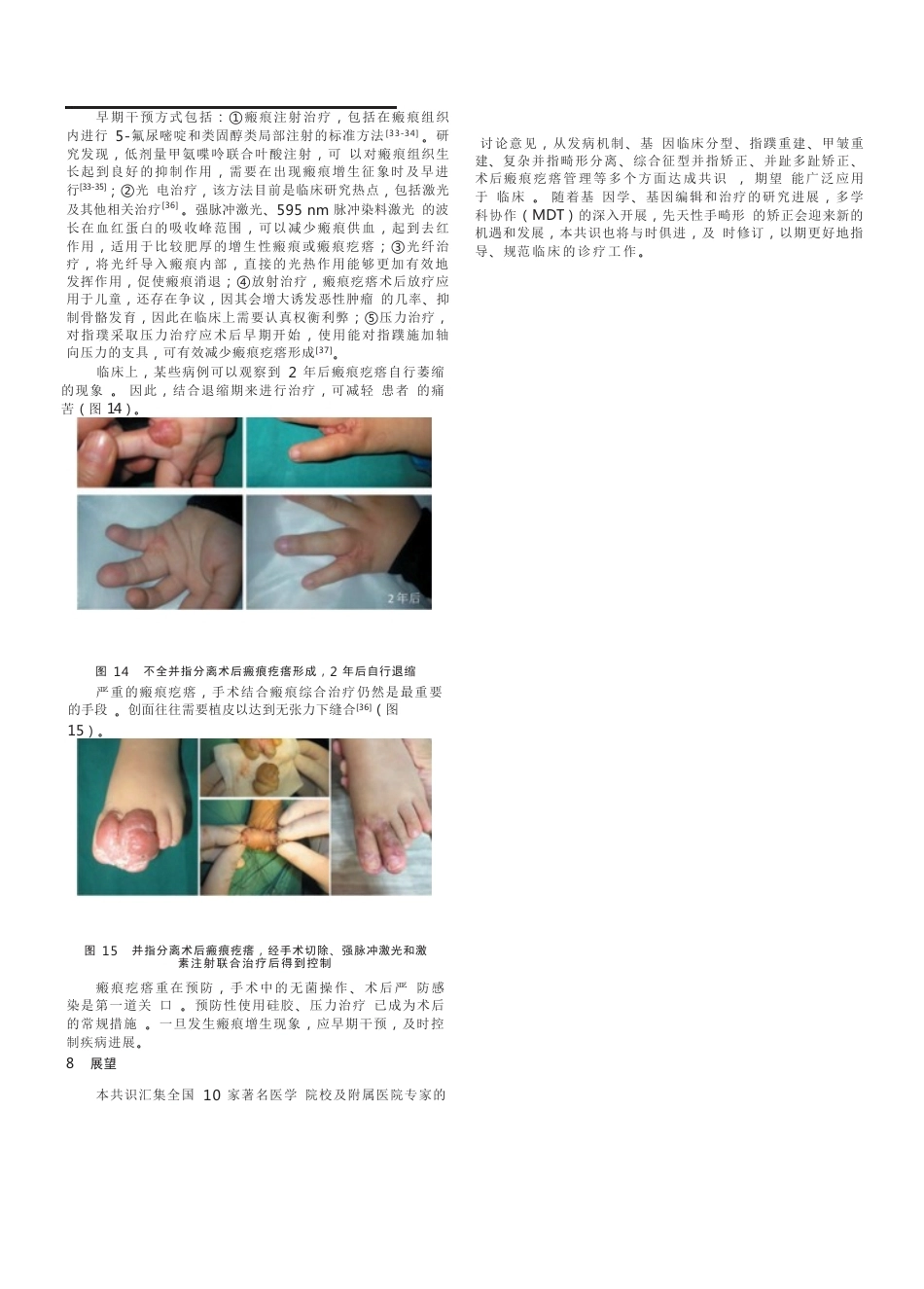 先天性并指畸形诊疗的专家共识(12)_第7页