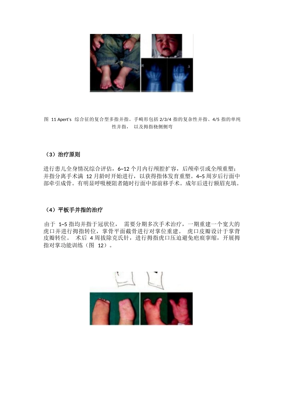先天性并指畸形诊疗专家共识(13)_第13页