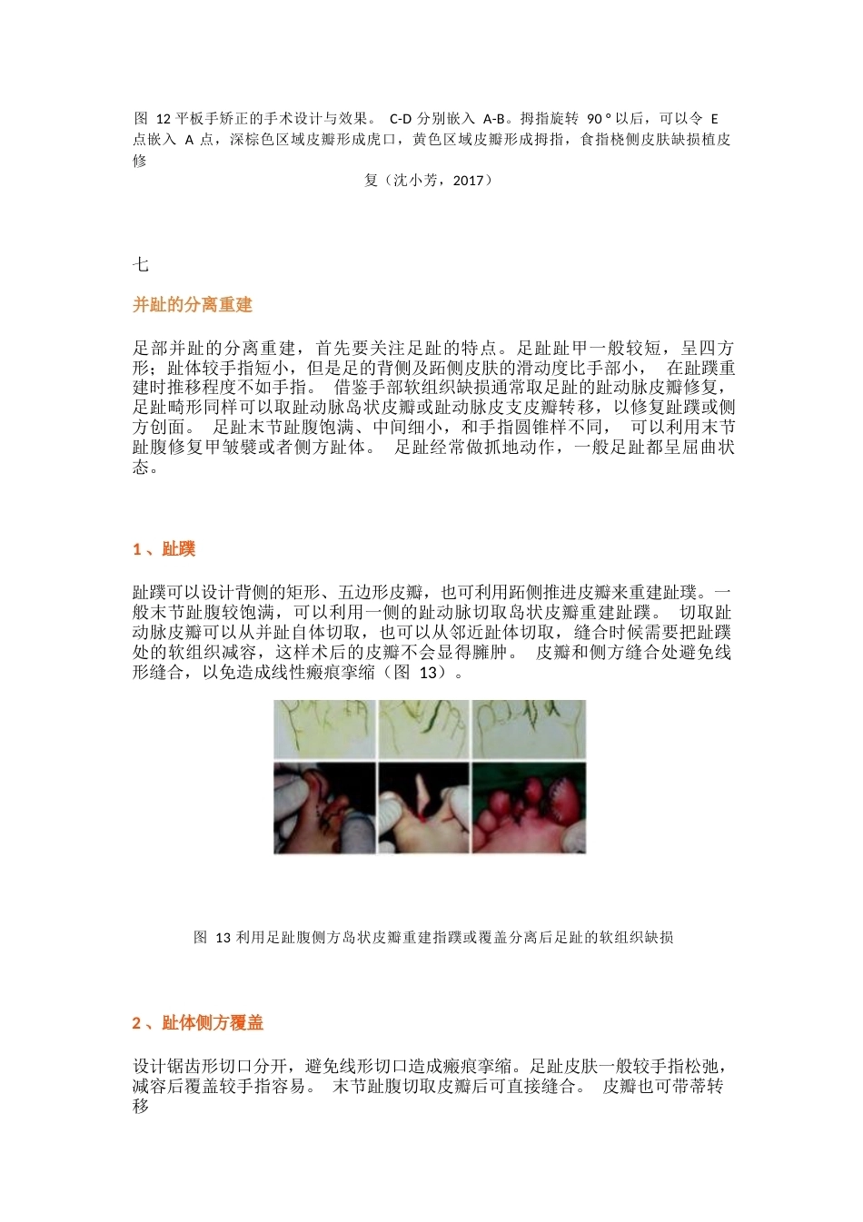 先天性并指畸形诊疗专家共识(13)_第14页