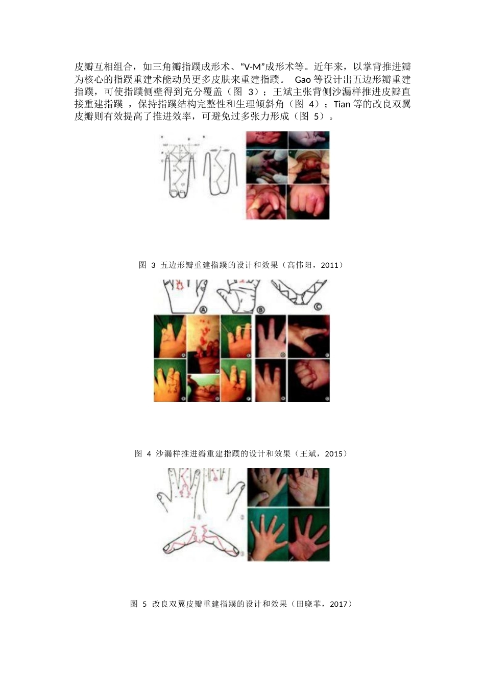 先天性并指畸形诊疗专家共识(13)_第6页