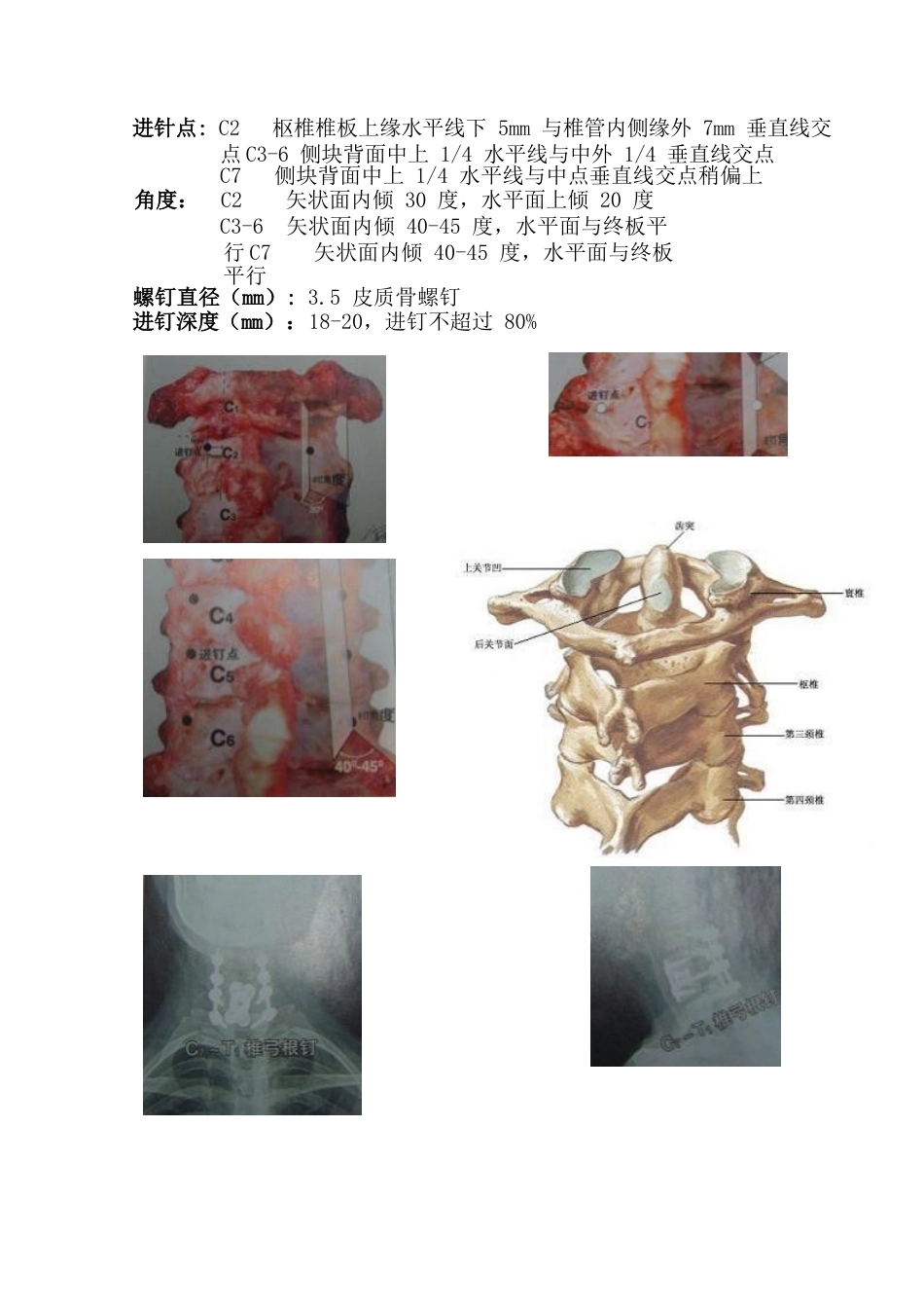 最全面的椎弓根钉打法(27)_第2页