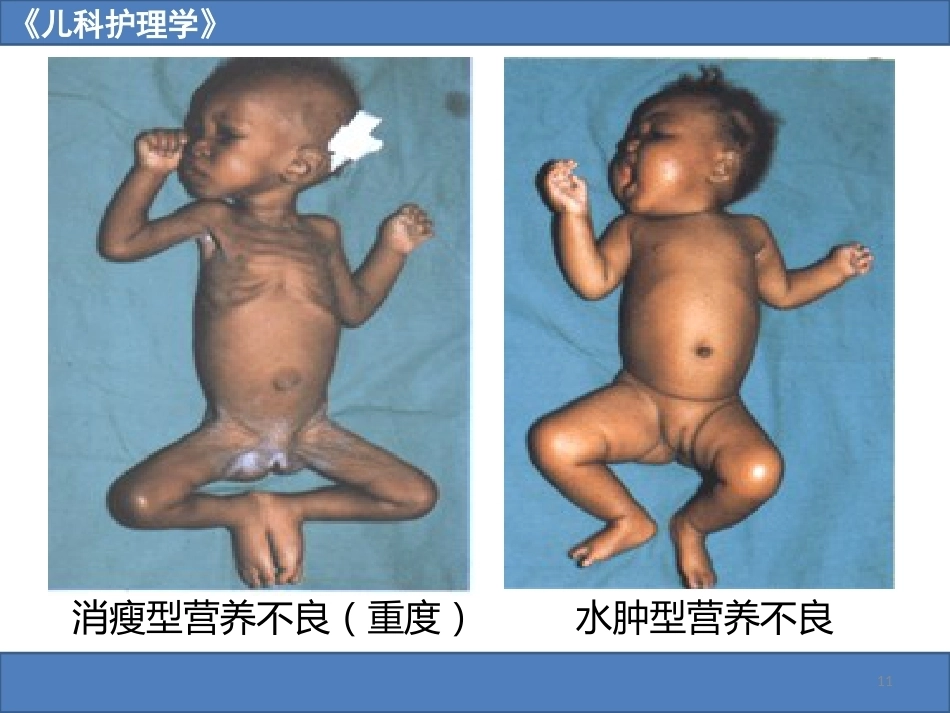 儿科护理学之营养障碍疾病患儿的护理_第11页