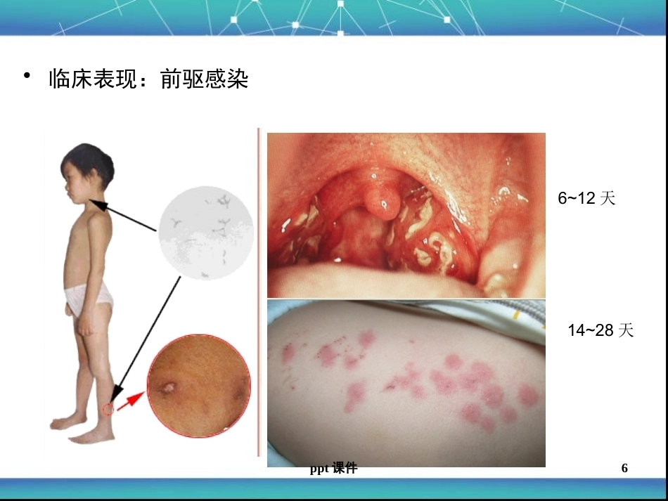 儿科急性肾小球肾炎ppt课件_第6页
