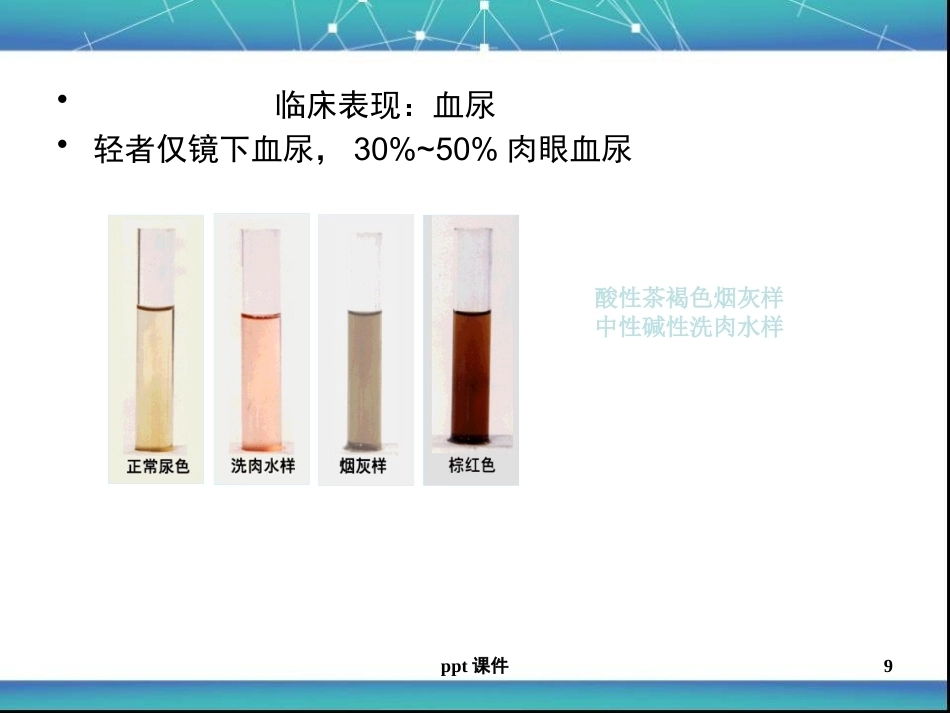 儿科急性肾小球肾炎ppt课件_第9页