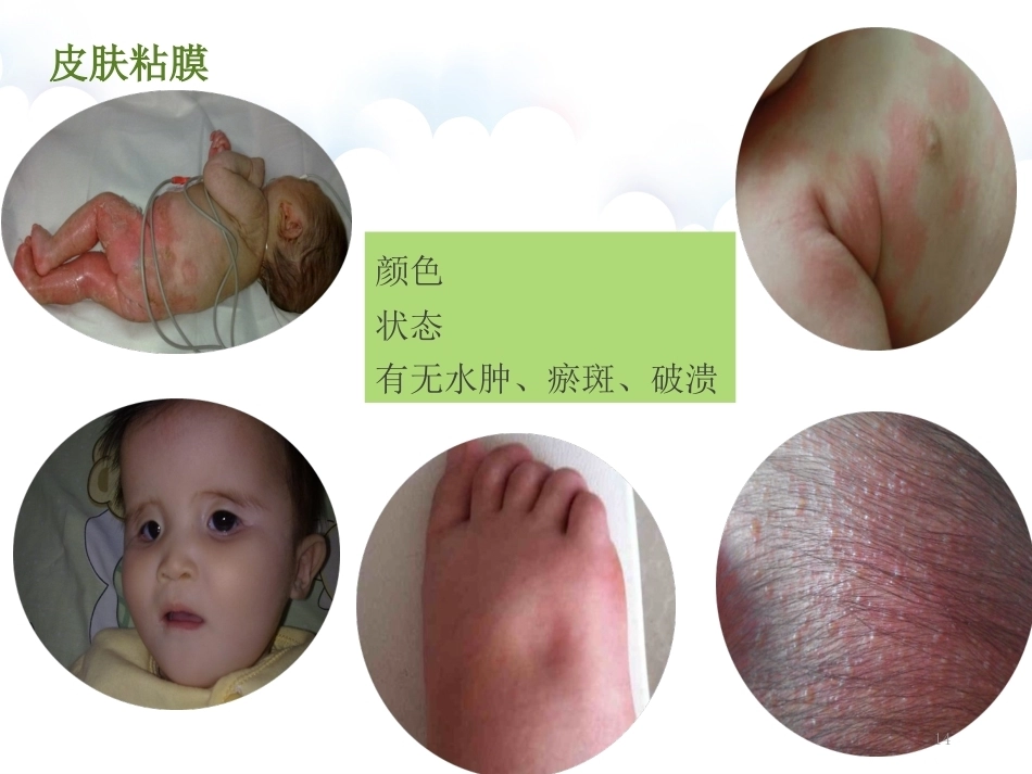 儿科患儿观察的要点及护理PPT_第14页