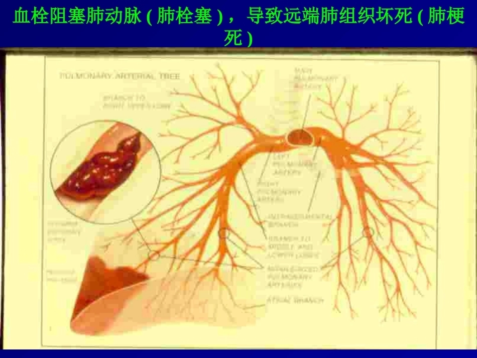 D二聚体及肺栓塞的诊断与治疗_第11页