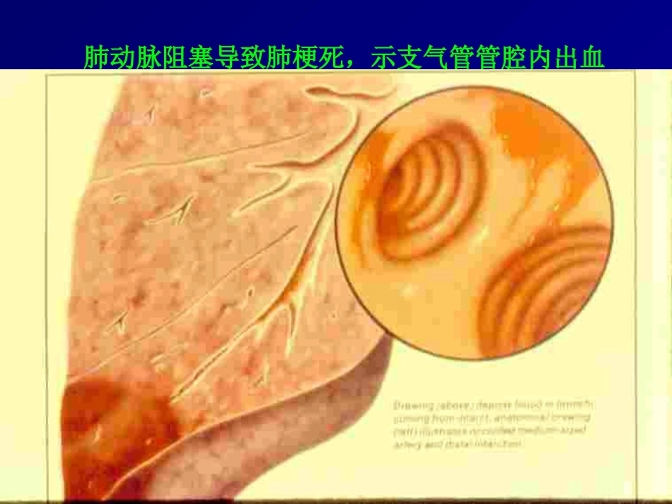 D二聚体及肺栓塞的诊断与治疗_第12页