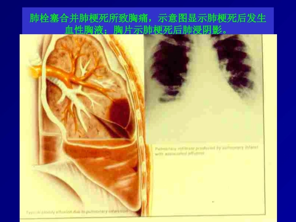 D二聚体及肺栓塞的诊断与治疗_第13页