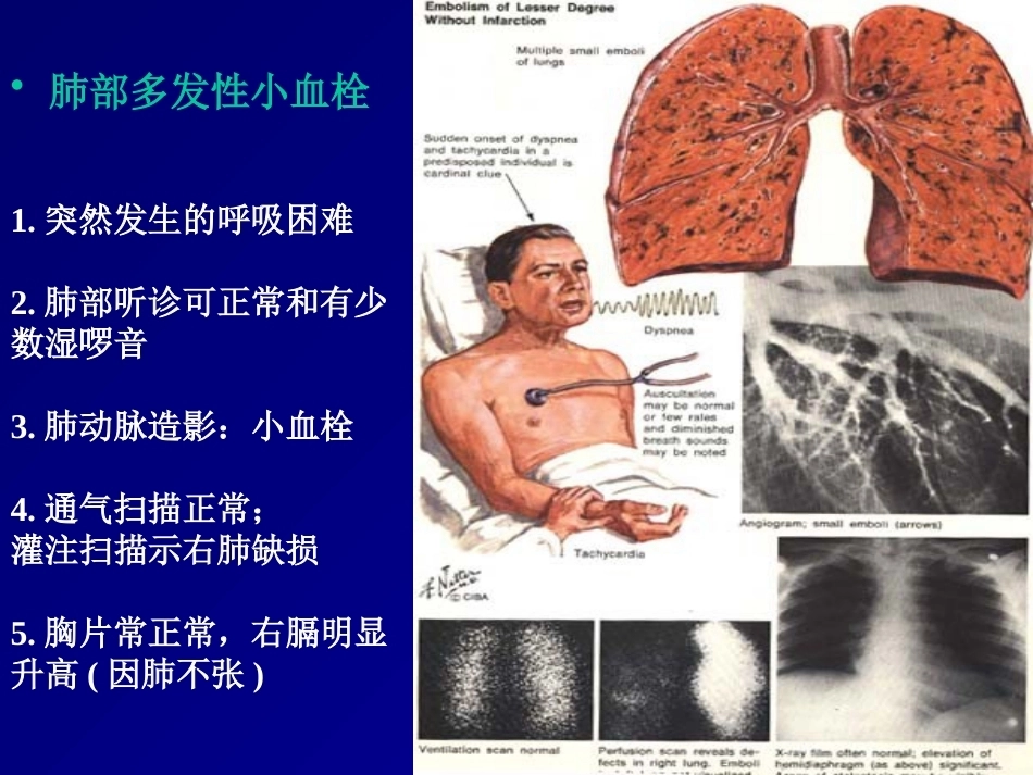 D二聚体及肺栓塞的诊断与治疗_第14页
