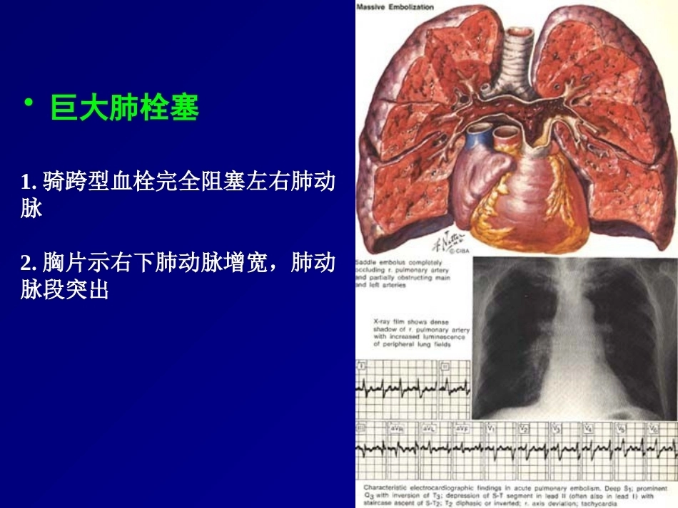 D二聚体及肺栓塞的诊断与治疗_第15页