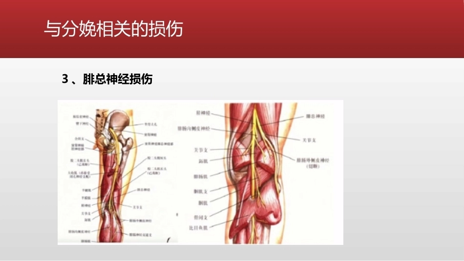 避免产科相关的下肢神经损伤的处理_第12页