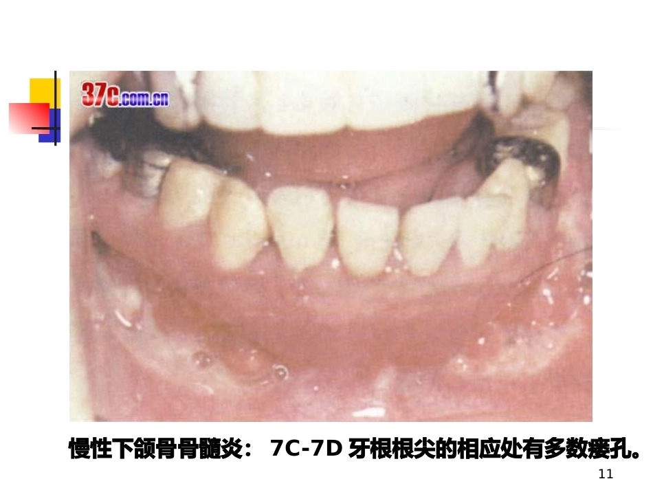 颌骨疾病--口腔组织病理学PPT课件_第11页