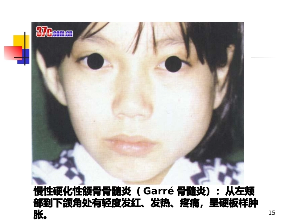 颌骨疾病--口腔组织病理学PPT课件_第15页