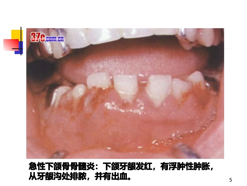 颌骨疾病--口腔组织病理学PPT课件_第5页