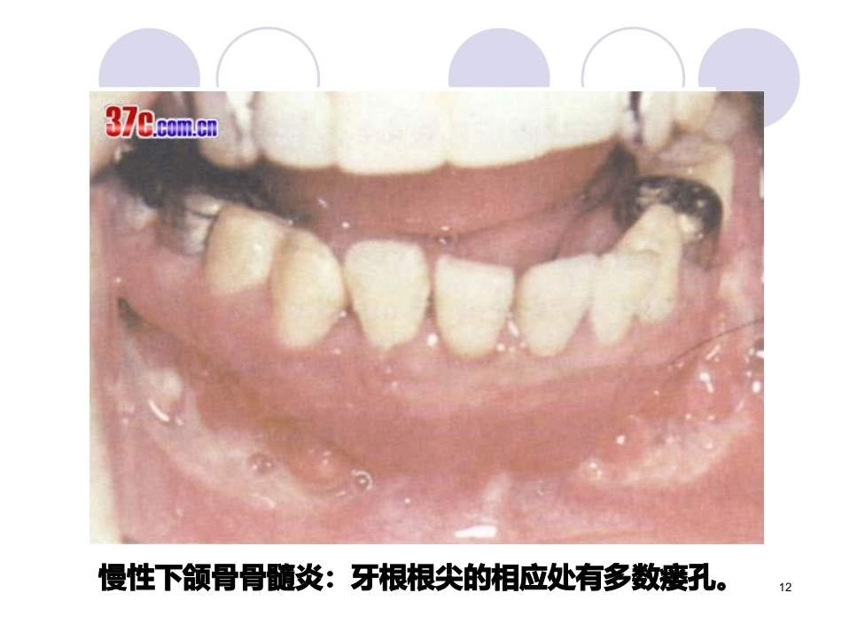 口腔组织病理学课件颌骨疾病_第12页