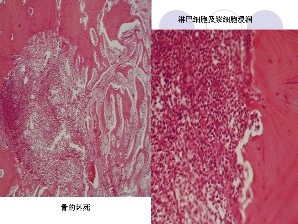 口腔组织病理学课件颌骨疾病_第14页