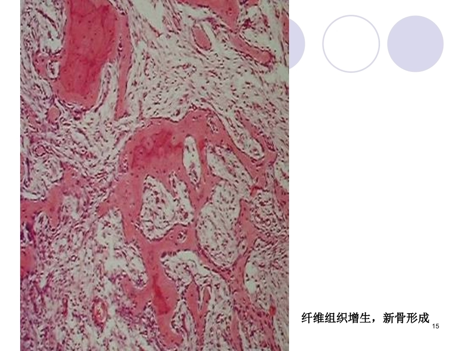 口腔组织病理学课件颌骨疾病_第15页