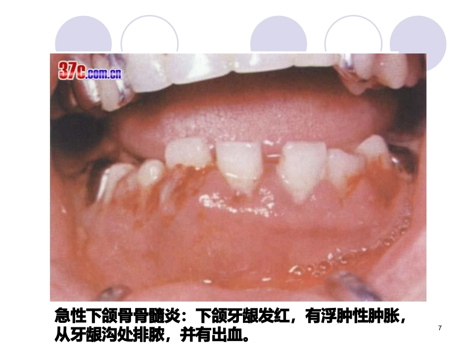 口腔组织病理学课件颌骨疾病_第7页