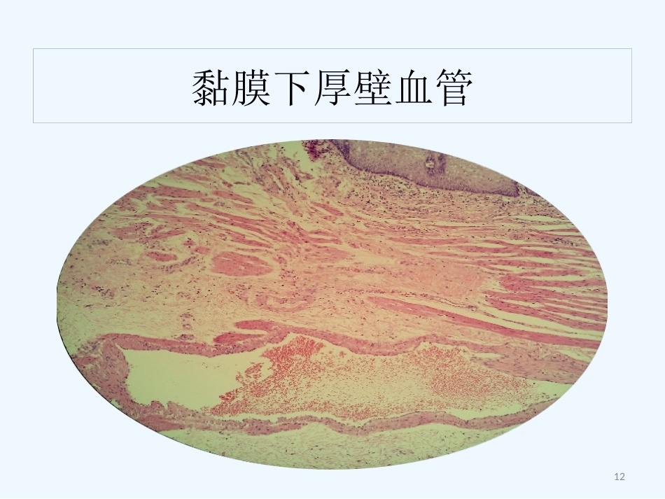 早期食管黏膜病变病理学形态_第12页