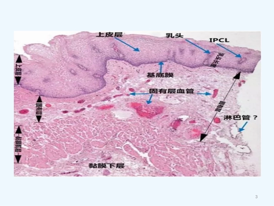 早期食管黏膜病变病理学形态_第3页