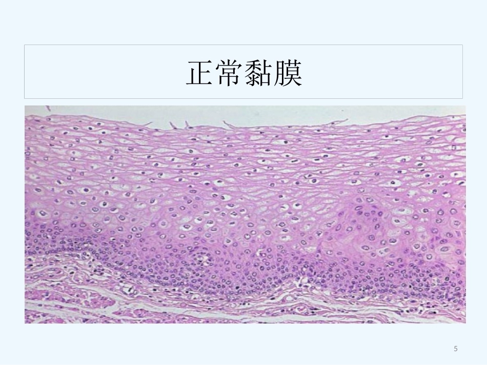 早期食管黏膜病变病理学形态_第5页