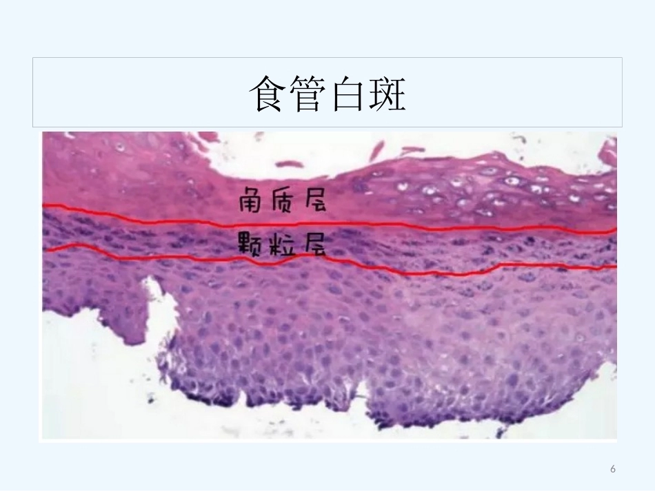 早期食管黏膜病变病理学形态_第6页
